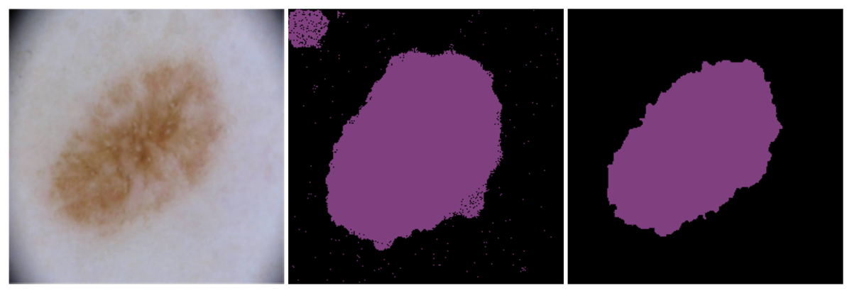 Diffusion models for medical image segmentation